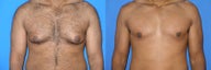 Male breast reduction (gynecomastia)