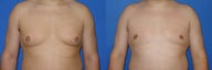 Male breast reduction (gynecomastia)