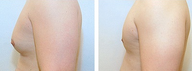 Gynecomastia surgery