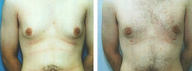 Gynecomastia surgery