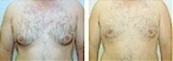 Gynecomastia