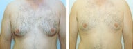 Gynecomastia surgery