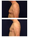 Gynecomastia / Male Breast Reduction