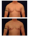 Gynecomastia / Male Breast Reduction