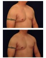 Gynecomastia / Male Breast Reduction