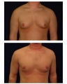 Male Breast Reduction