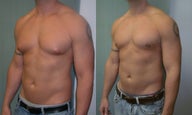 Gynecomastia