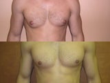 Liposuction for Male Breast Reduction/Gynecomastia