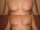 Liposuction for Gynecomastia ( Male Breast Reduction)