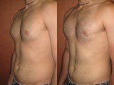 Liposuction for Gynecomastia (Male Breast Reduction)