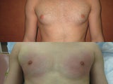 Liposuction for Gynecomastia ( Male Breasst Reduction)