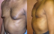 Liposuction for Gynecomastia (Male Breast Reduction)