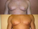 Liposuction for Gynecomastia ( Male Breast Reduction)