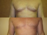 Liposuction for Gynecomastia (Male Breast Reduction)