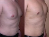Liposuction for Gynecomastia (Male Breast Reduction)