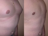 Liposuction for Gynecomastia (Male Breast Reduction)