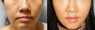 Endoscopic Mid Facelift by Wave Plastic Surgery & Dermatology Center
