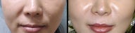 Endoscopic Mid Facelift by Wave Plastic Surgery & Dermatology Center