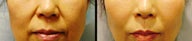Endoscopic Mid Facelift