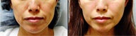 Endoscopic Mid Facelift