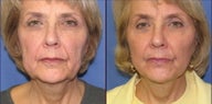 Short scar facelift before and after