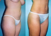 Mini-Tummy Tuck with Liposuction