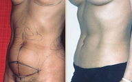 Abdominoplasty