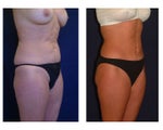 Tummy Tuck or Abdominoplasty
