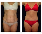 Tummy Tuck or Abdominoplasty