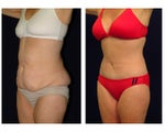 Tummy Tuck or Abdominoplasty