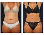 Tummy Tuck or Abdominoplasty