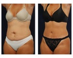 Tummy Tuck or Abdominoplasty