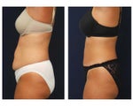 Tummy Tuck or Abdominoplasty