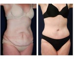 Tummy Tuck or Abdominoplasty