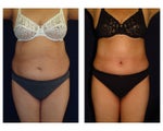 Tummy Tuck or Abdominoplasty