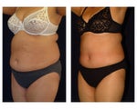 Tummy Tuck or Abdominoplasty
