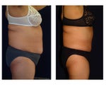 Tummy Tuck or Abdominoplasty