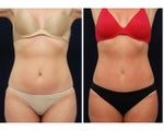 Tummy Tuck or Abdominoplasty
