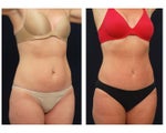 Tummy Tuck or Abdominoplasty