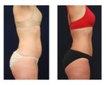 Tummy Tuck or Abdominoplasty