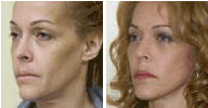 Facelift