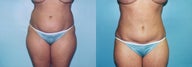 Mini Tummy Tuck with Lipo