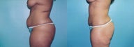 Mini Tummy Tuck with Lipo