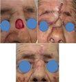 Nasal bridge defect repair after Mohs Surgery