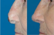 Nasal Reconstruction after Mohs Surgery