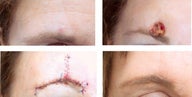 MOHS Skin Cancer Surgery
