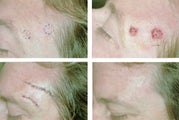 MOHS Skin Cancer Surgery