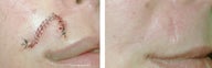 MOHS Skin Cancer Surgery