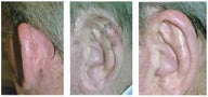 MOHS Skin Cancer Surgery