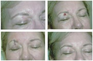 MOHS Skin Cancer Surgery